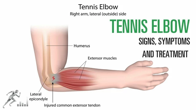 Post - Tennis Elbow Treatment?